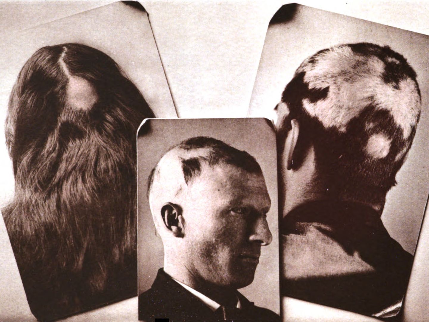 Alopezie