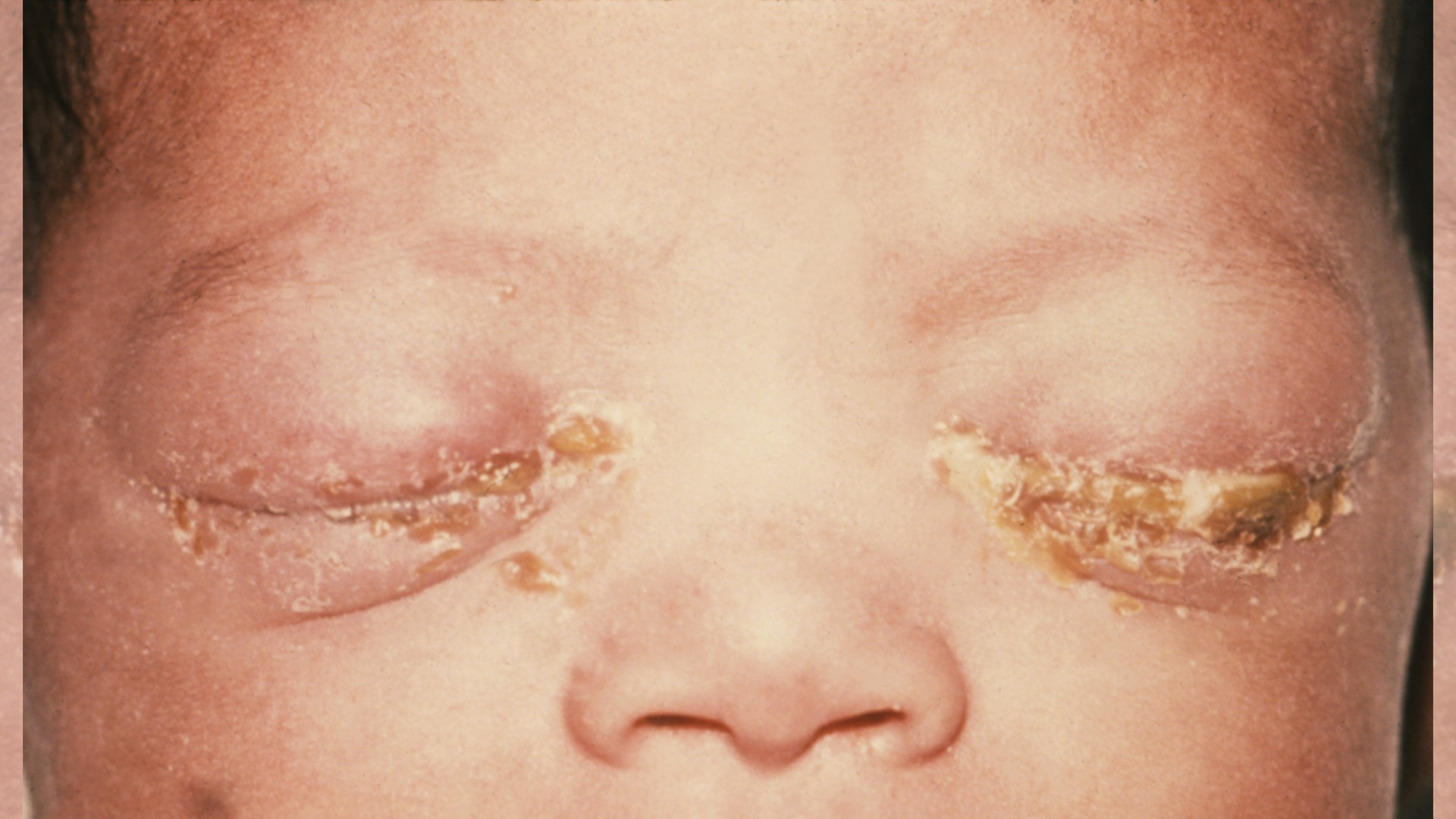 Betroffene Augen