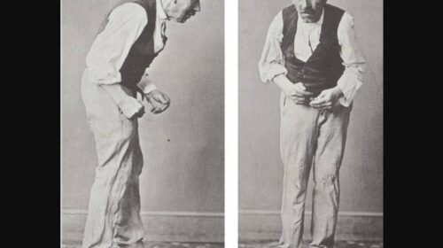 Parkinson Patient 